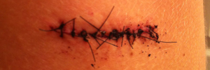 Skin Cancer Wound Reconstruction Optimized