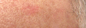 Actinic Keratosis Optimized